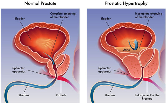 A Natural Solution for Treating Benign Prostatic Hyperplasia (Enlarged Prostate)